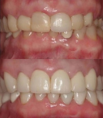 Gum Recontouring