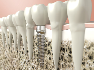 Very high resolution 3d rendering of a dental implant