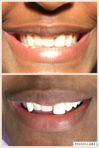 Linden Dental Before/After
