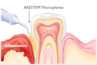 Arestin Therapy