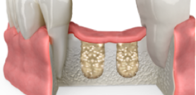 Oral Surgery Bone Graft