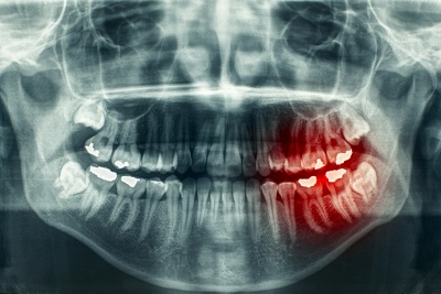 Traumatic Dental Injury